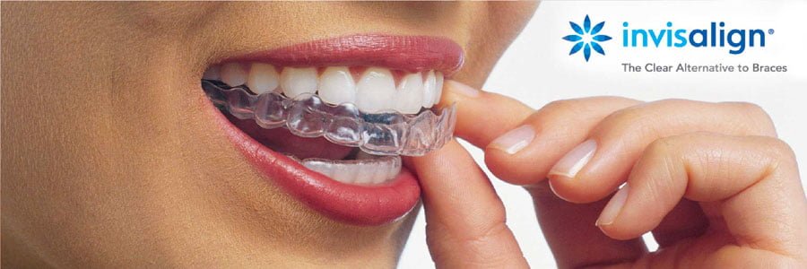 Invisalign by Fraser Street Dentist in Vancouver, BC